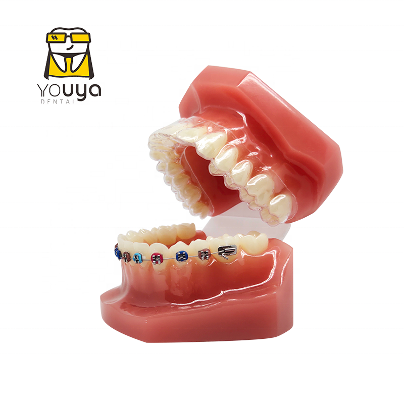 Invisible Orthodontic Dental Teeth Model With Metal Brackets